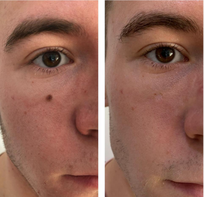 plexr mole removal before and after