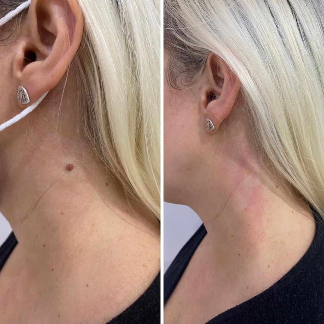 Neck Mole removal before and after