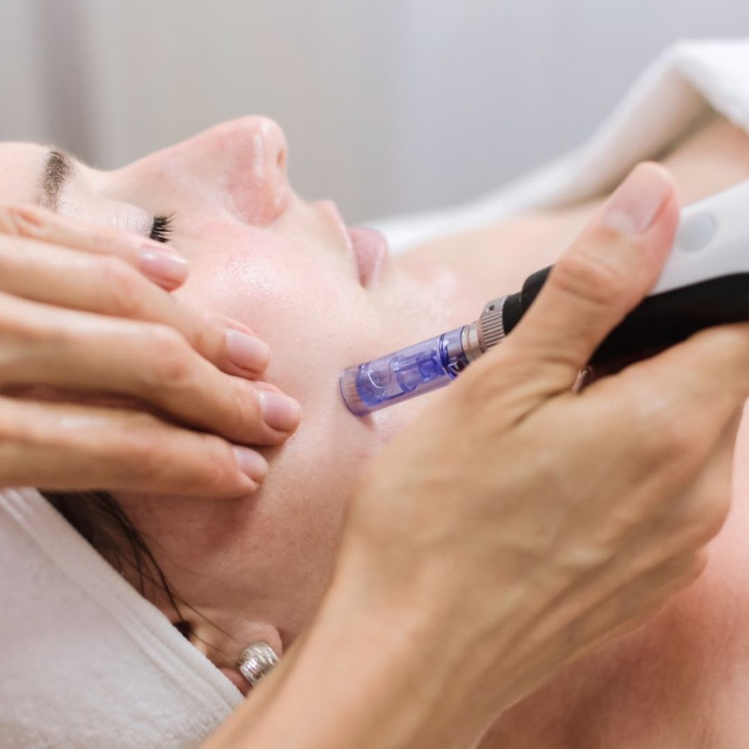 Dermapen microneedling