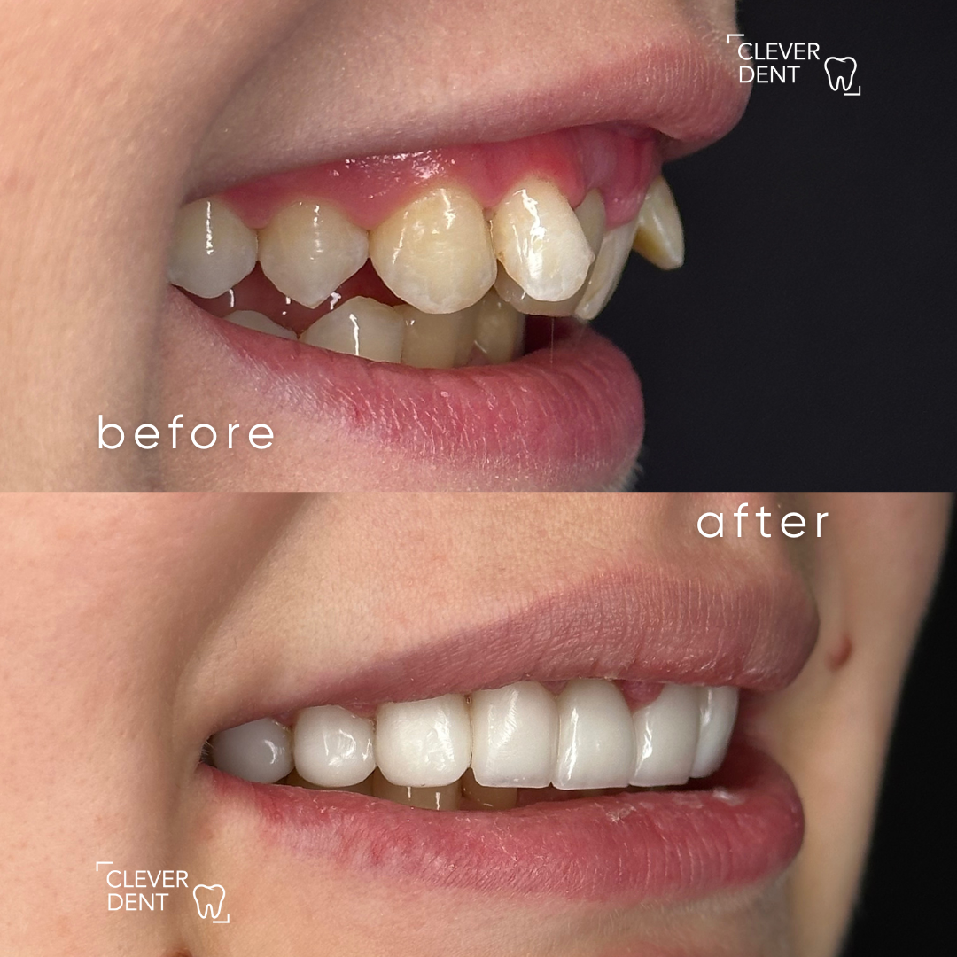 Clever Dent – The Solution