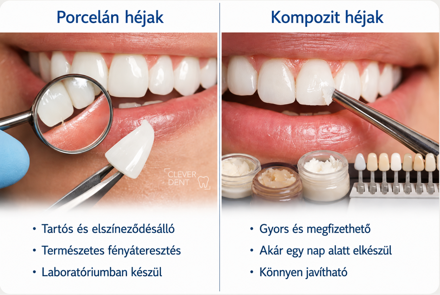 Porcelán és kompozit fogászati héjak összehasonlítása