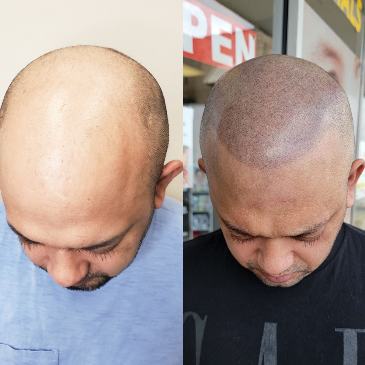 Before and after of Scalp Micropigmentation 