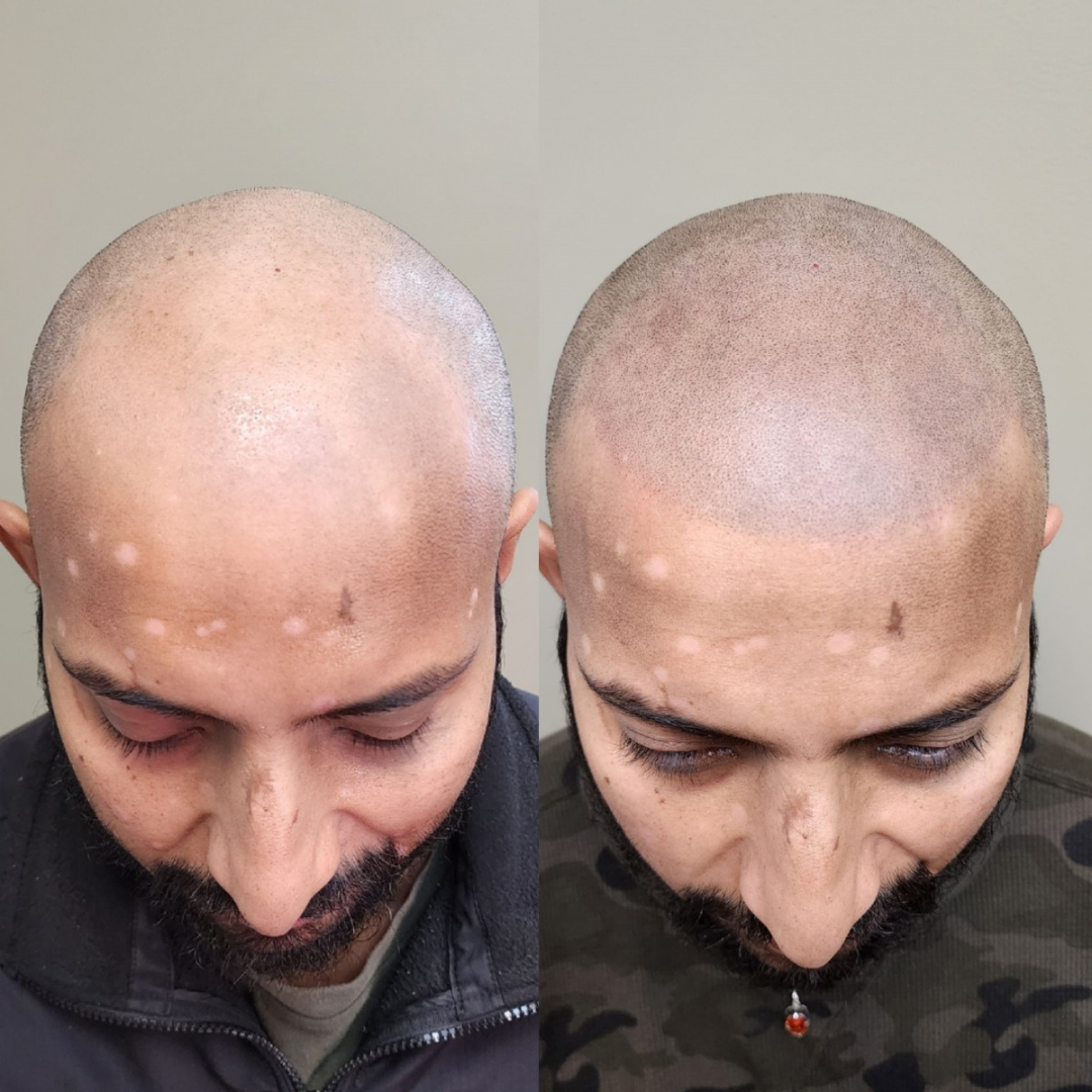 Before and after of Scalp Micropigmentation 