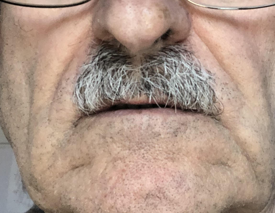 After Treatment