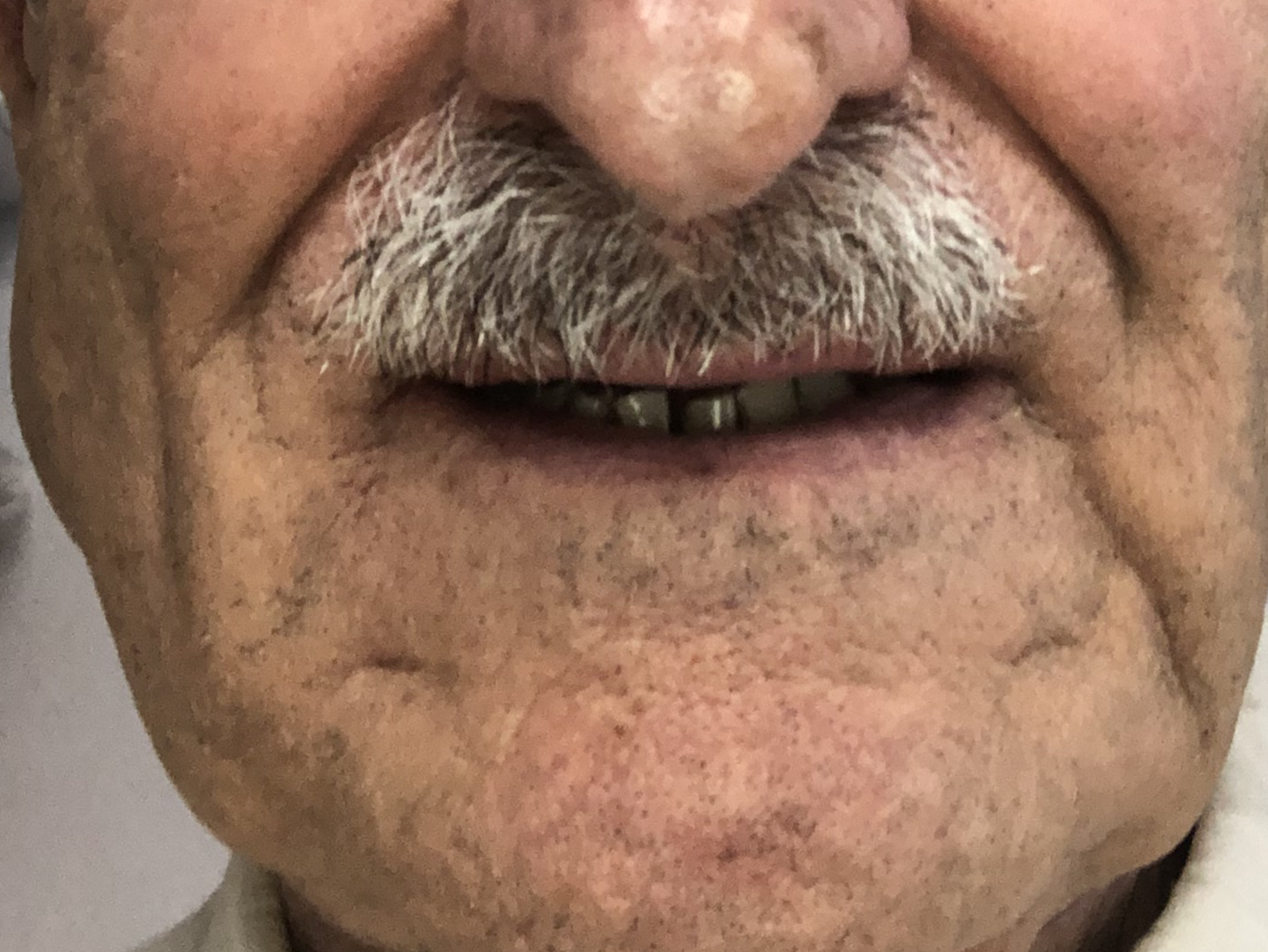 Before Treatment
