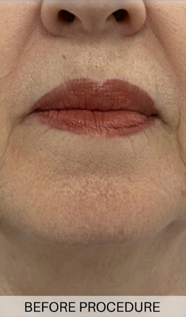Before Treatment