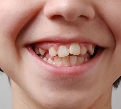 Unbalanced Oral Habits 