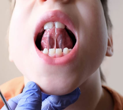 Tongue Tie Therapy 