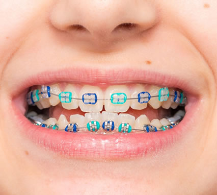 Orthodontic Relapse 