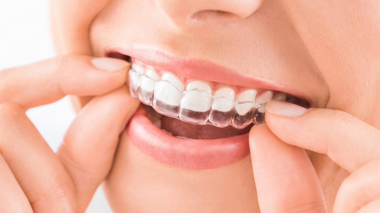 Invisalign — mascherine trasparenti Studio Dentistico 25