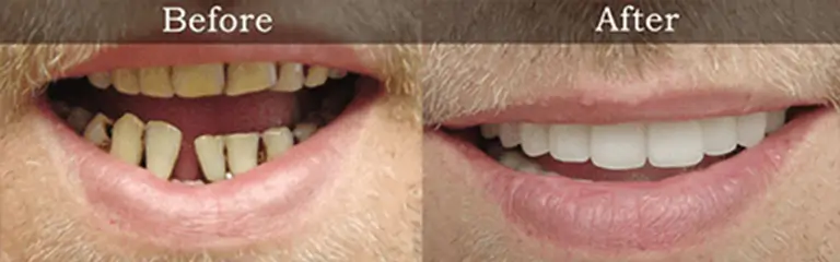 Smile transformation before and after #2 &mdash; Rozenberg Dental NYC