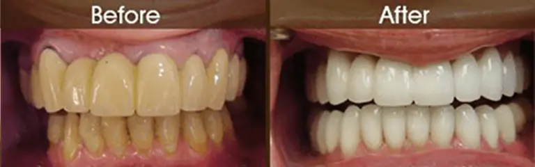 Smile transformation before and after #7 &mdash; Rozenberg Dental NYC