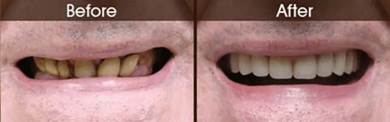 Smile transformation before and after #6 &mdash; Rozenberg Dental NYC