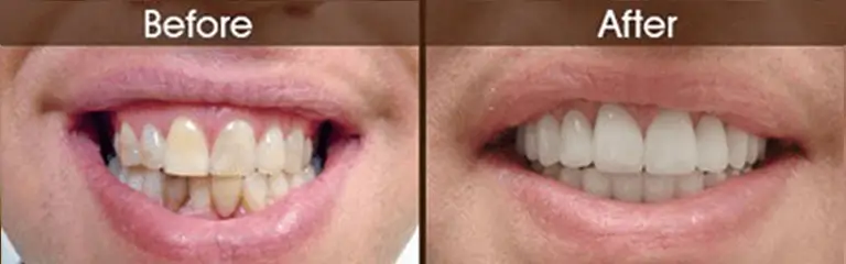 Smile transformation before and after #3 &mdash; Rozenberg Dental NYC