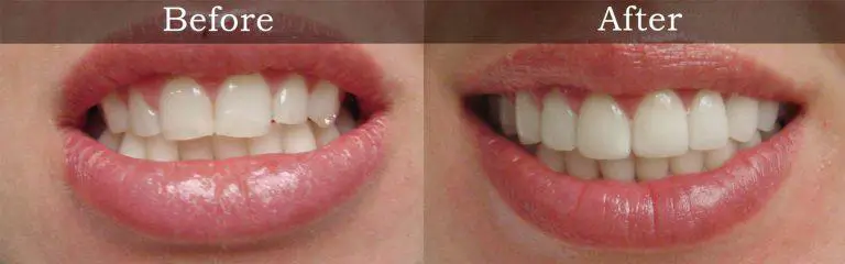 Smile transformation before and after #5 &mdash; Rozenberg Dental NYC