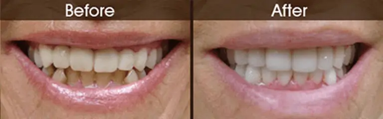 Smile transformation before and after #4 &mdash; Rozenberg Dental NYC