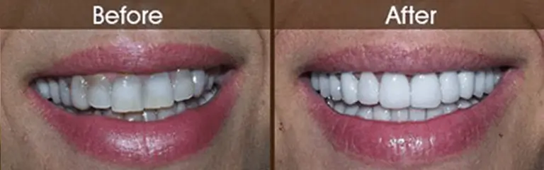 Smile transformation before and after #1 &mdash; Rozenberg Dental NYC