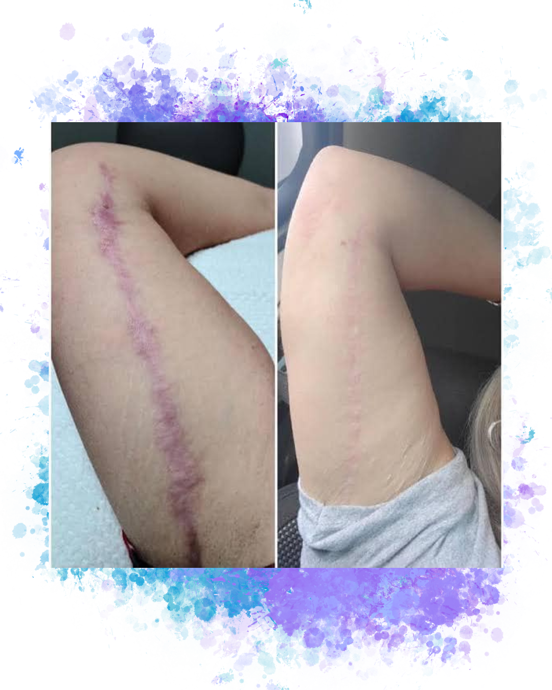 Red, deep scars almost completely removed by treatments