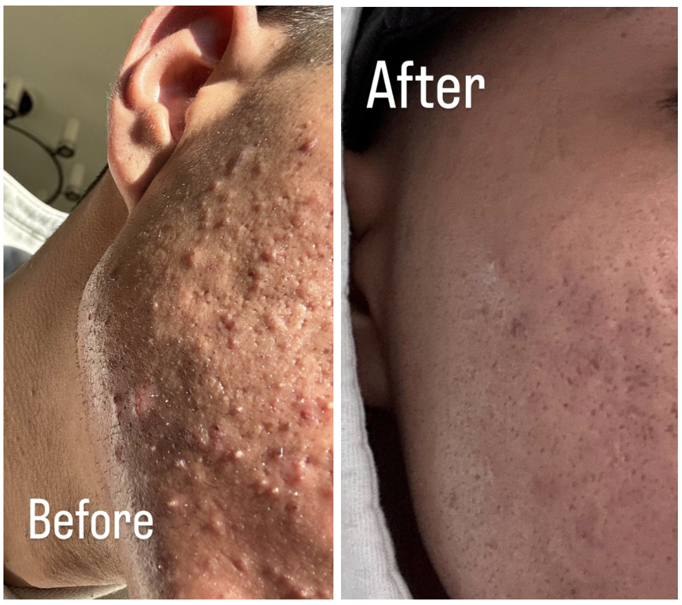 Red, deep scars almost completely removed by treatments