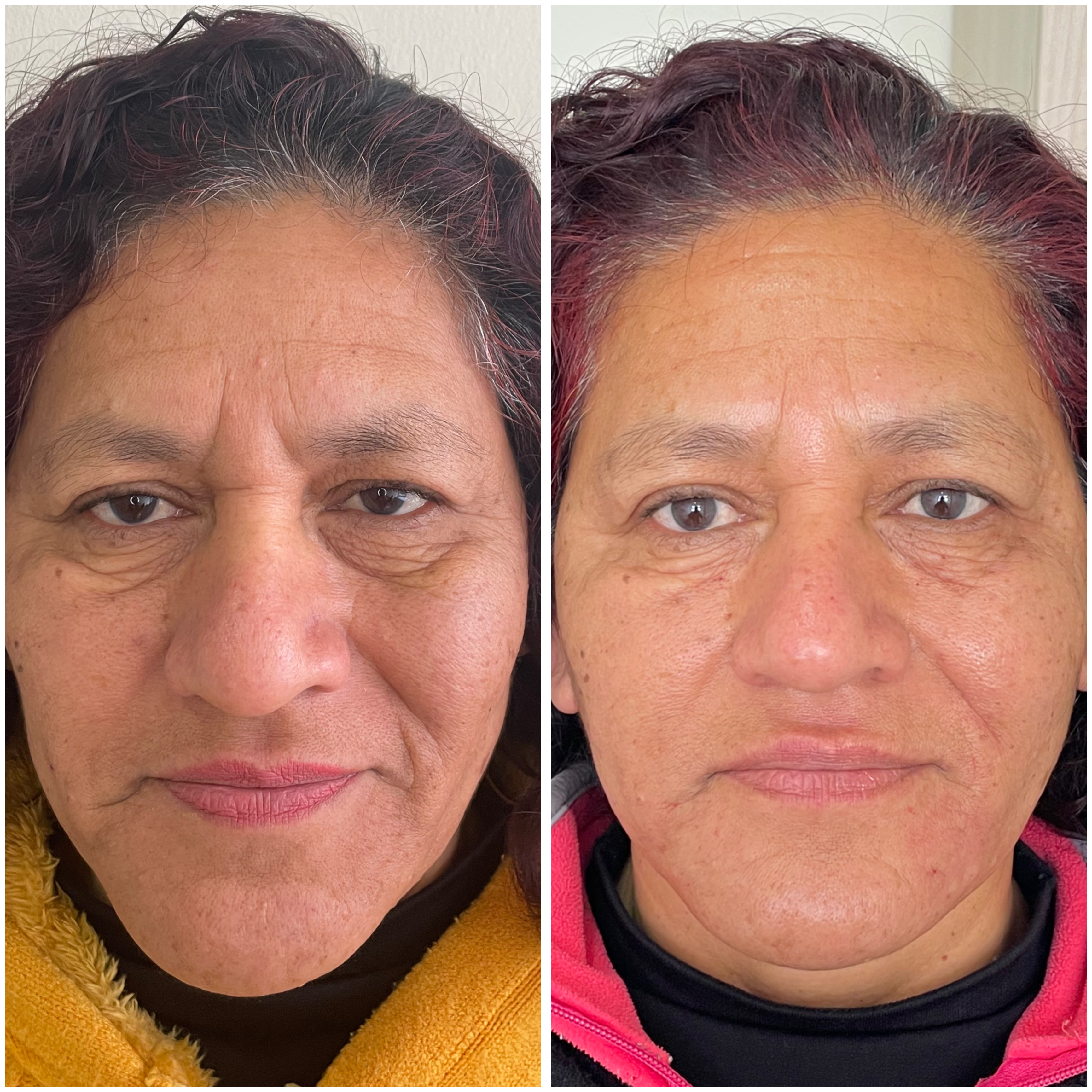 Antes y Después - Ácido Hialurónico