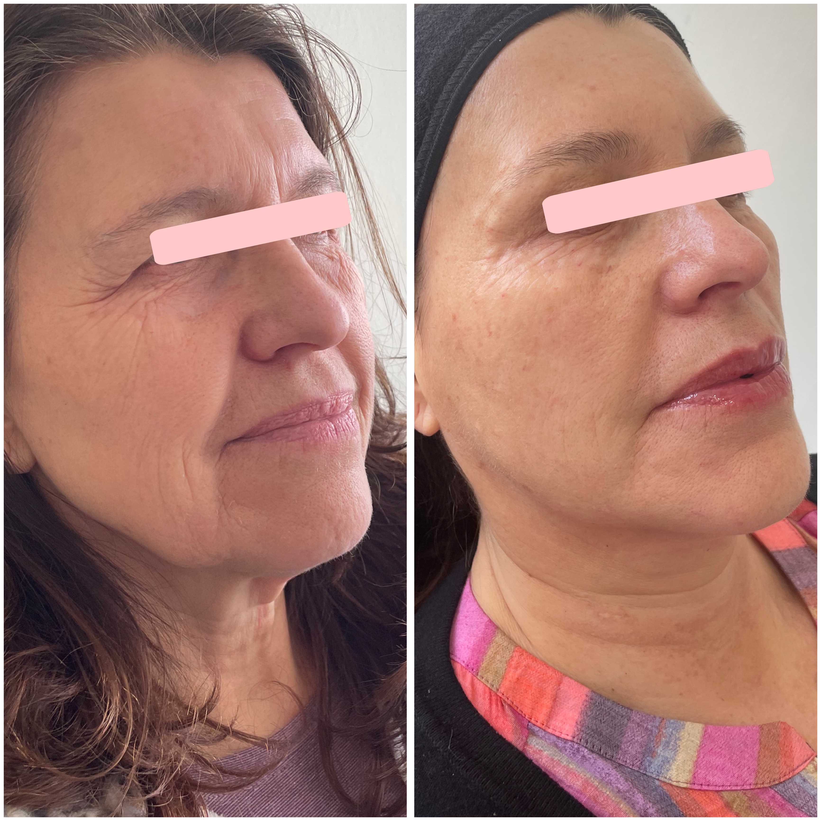 Antes y Después - Clínica Küme Essence