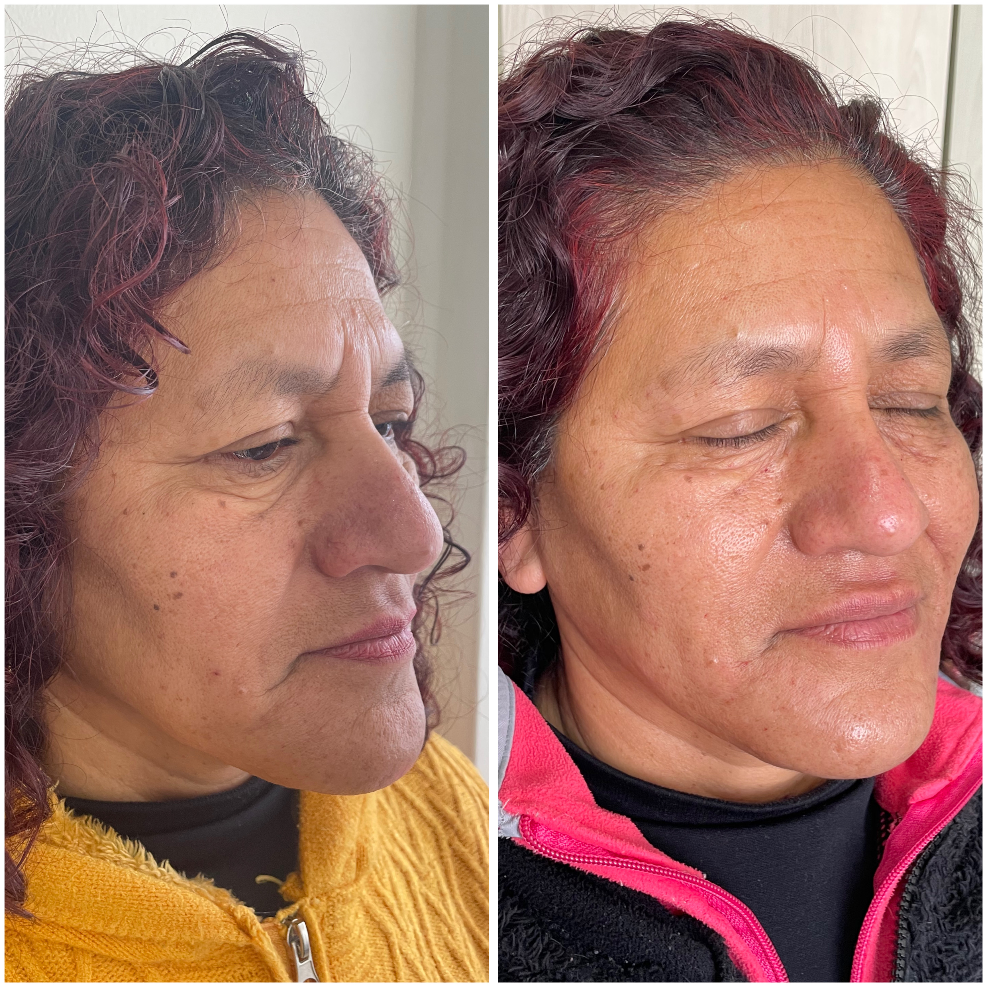 Antes y Después - Dra Victoria Oyarzún