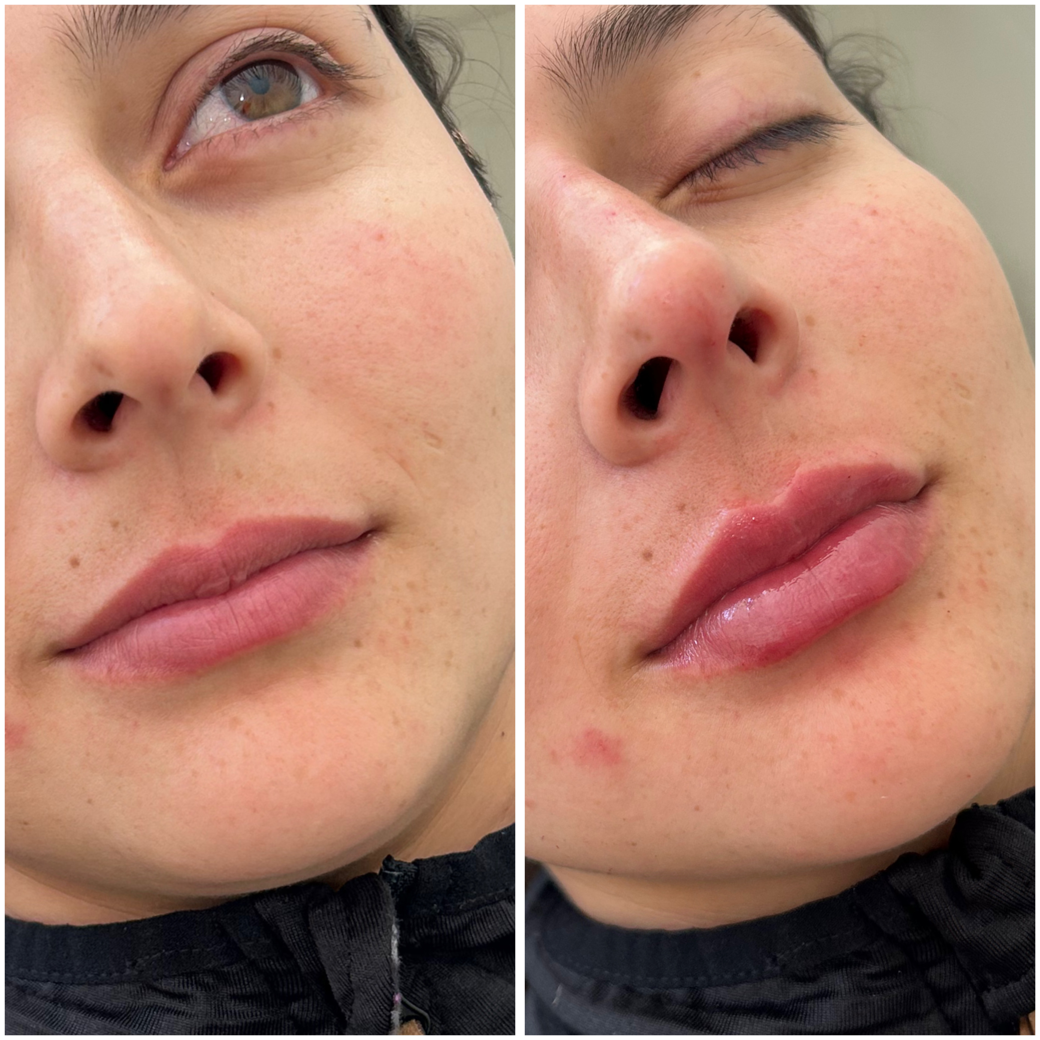 Antes y Después - Tratamiento Facial