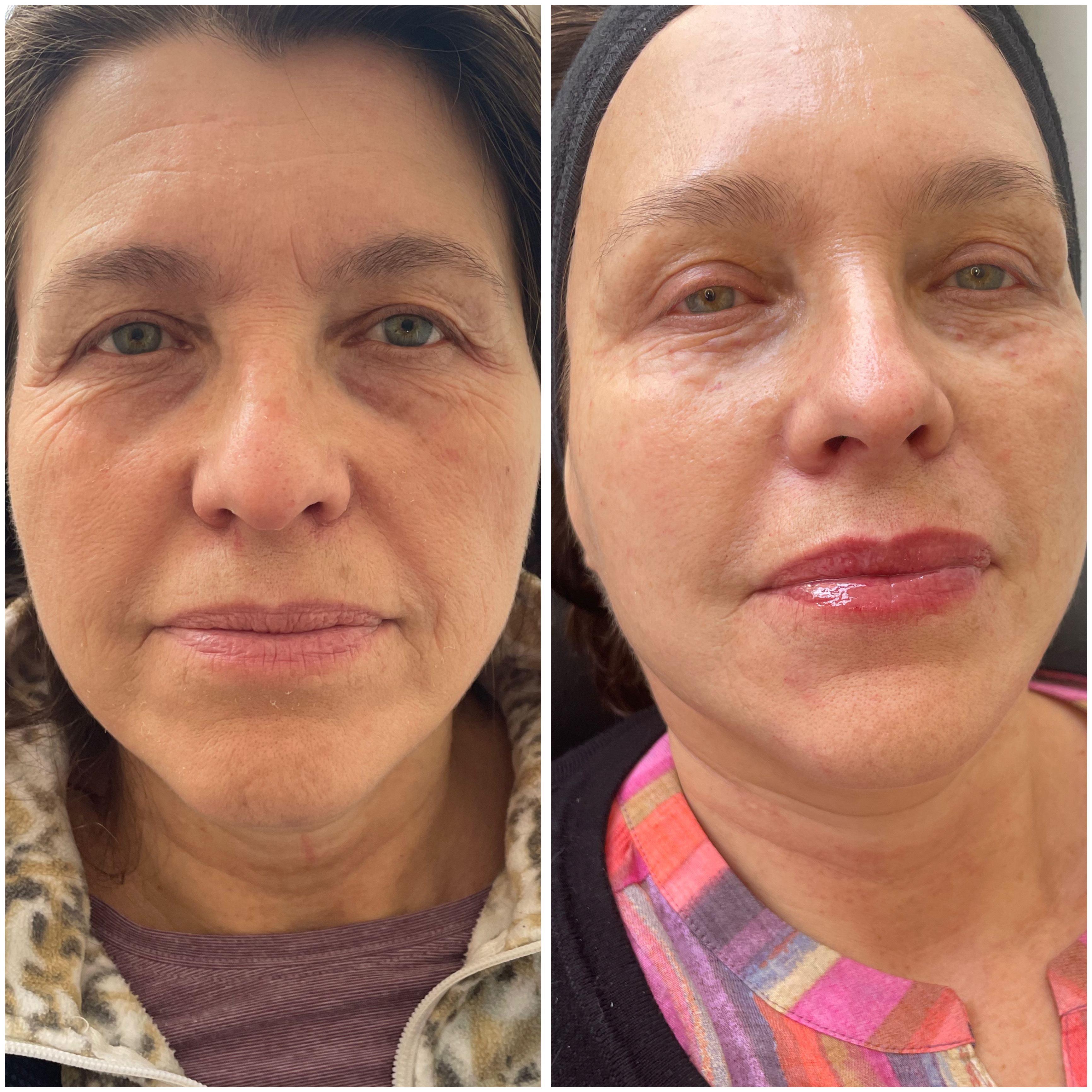 Antes y Después - Bioestimuladores