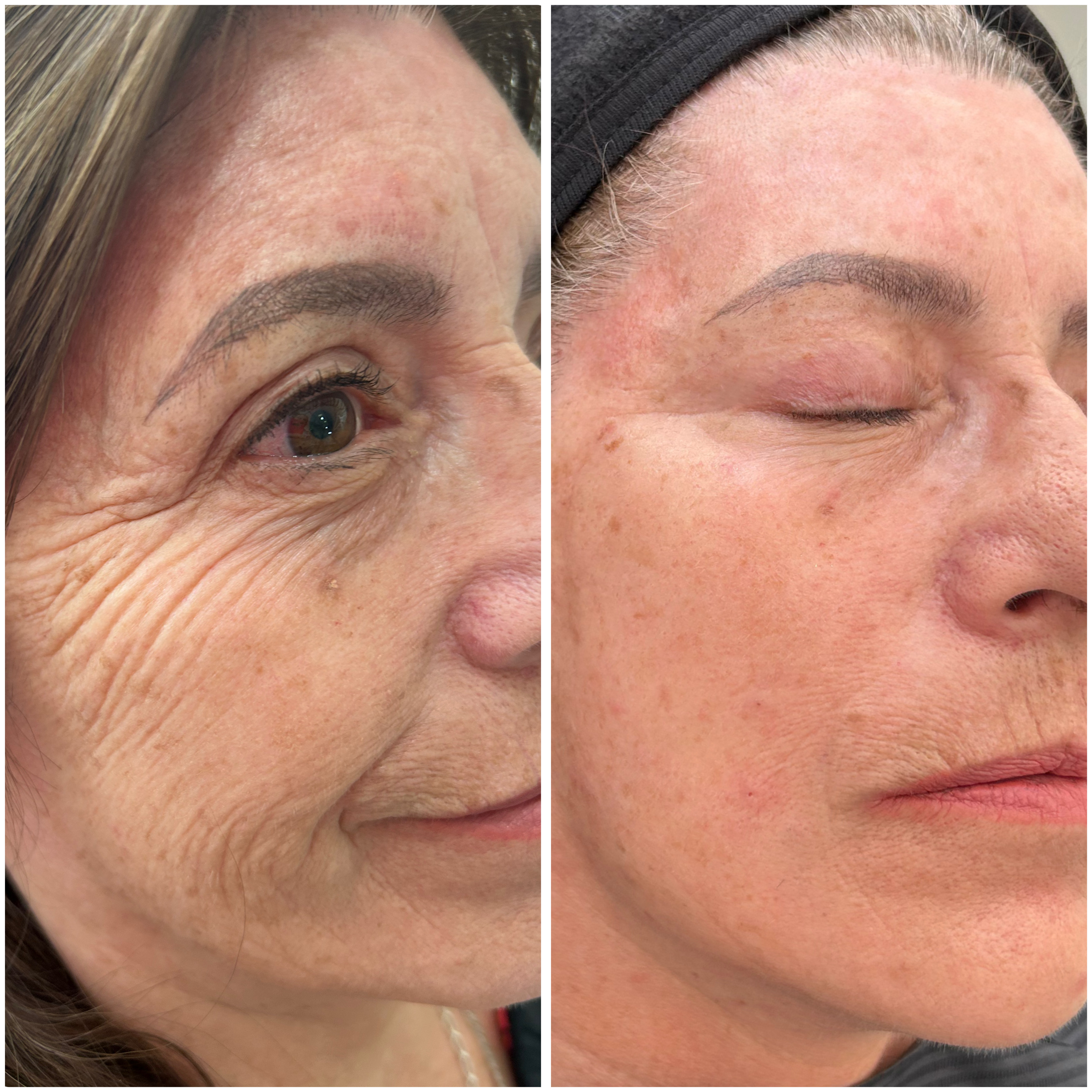 Antes y Después - Botox Providencia