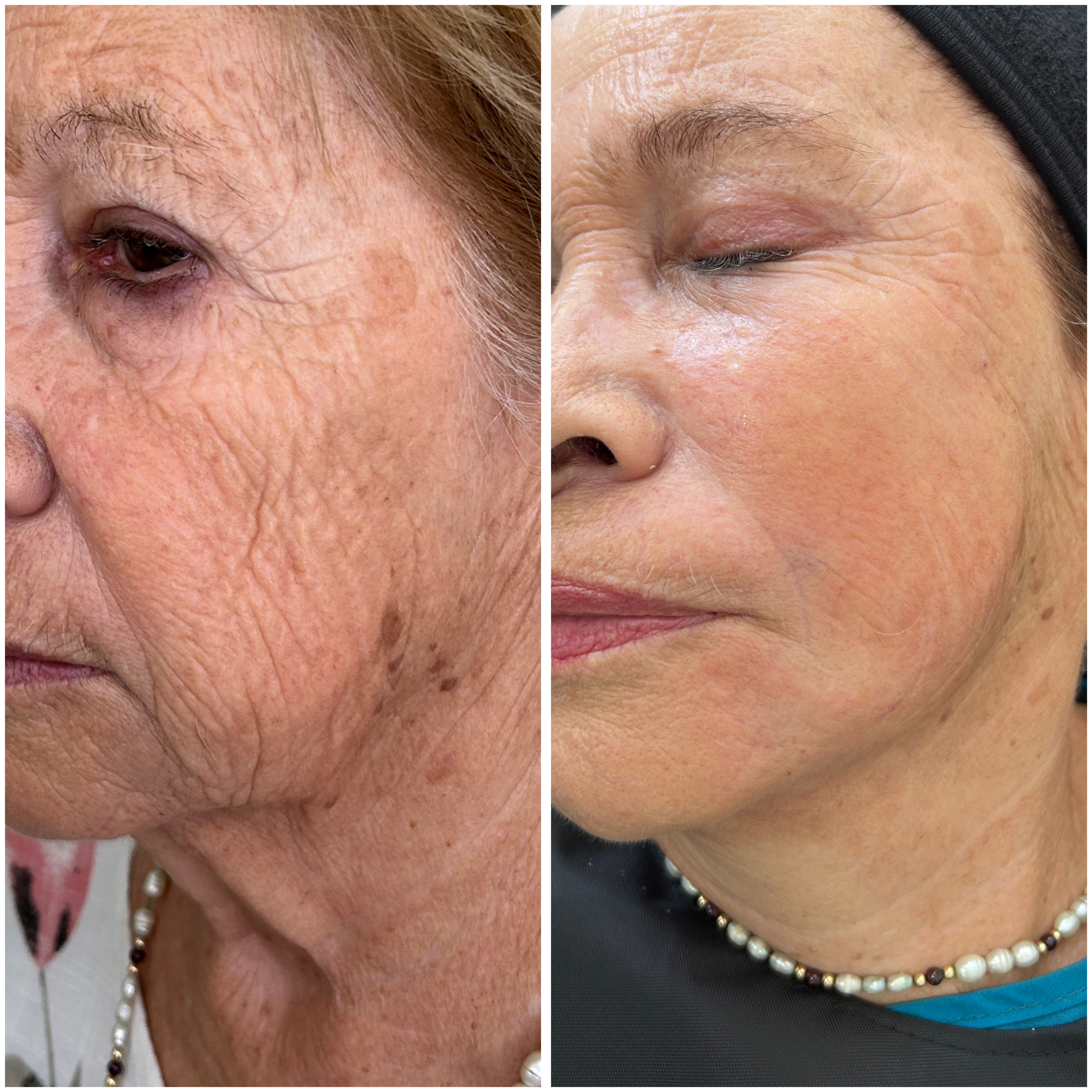 Antes y Después - Medicina Estética Providencia