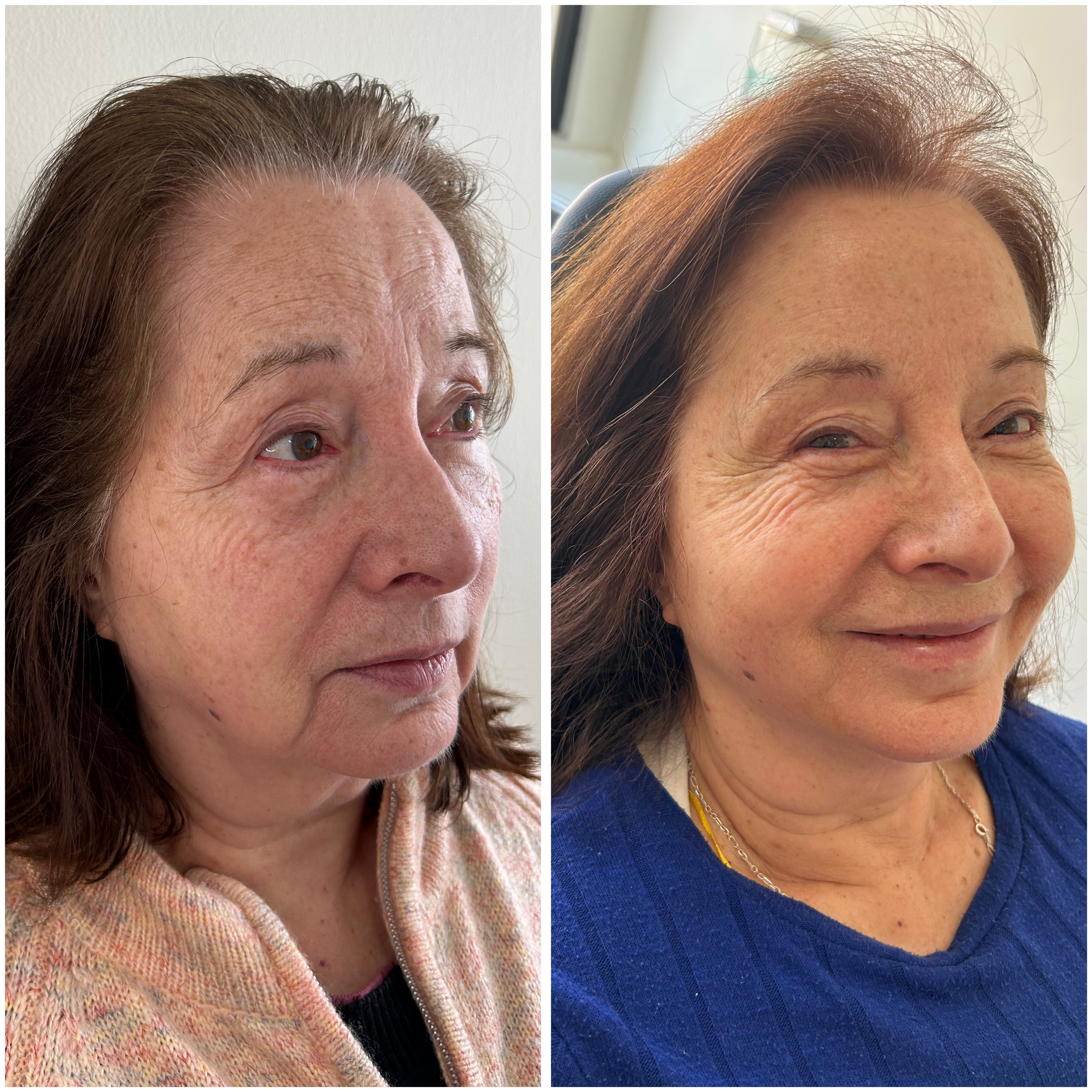 Antes y Después - Rejuvenecimiento Facial