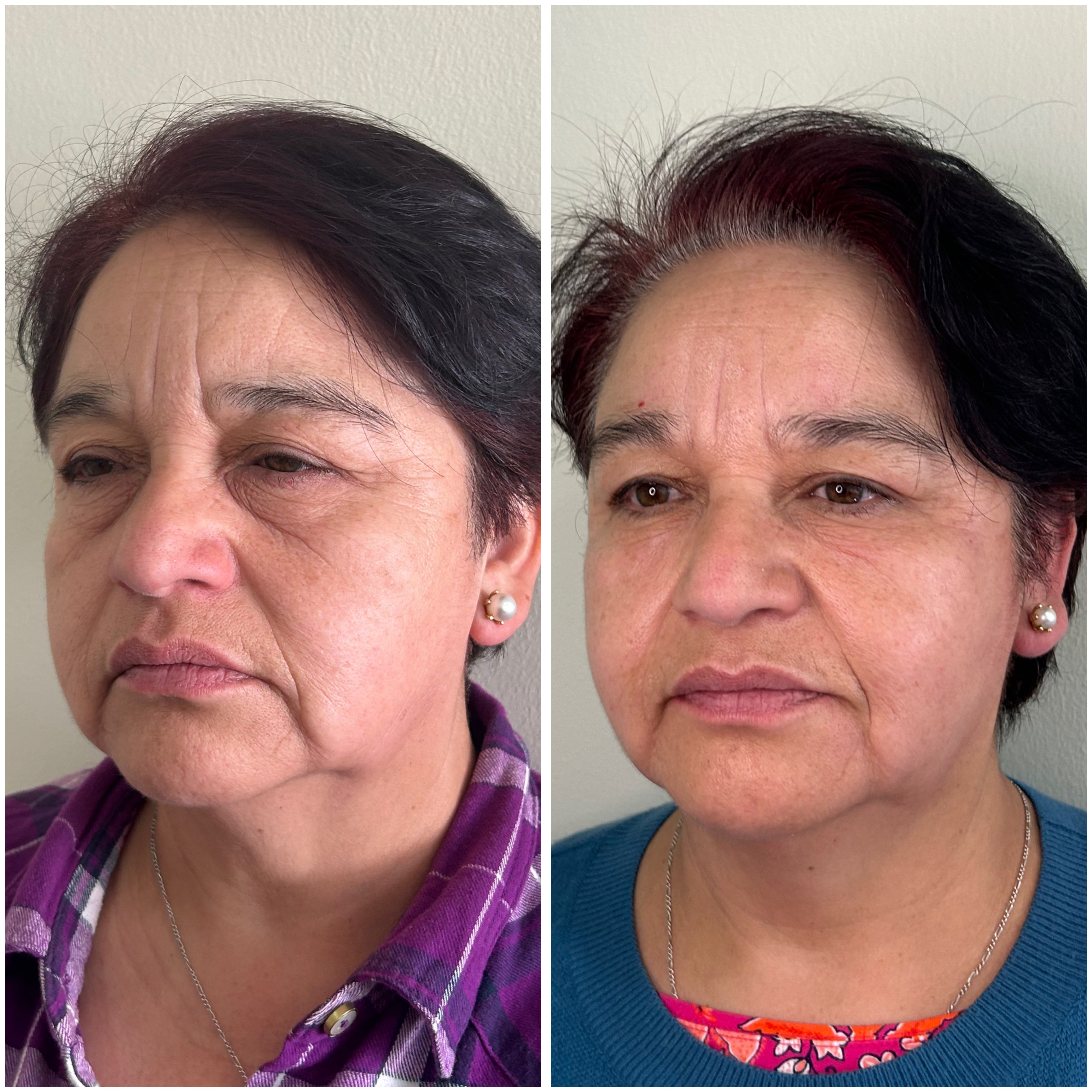 Antes y Después - Armonización Facial Providencia