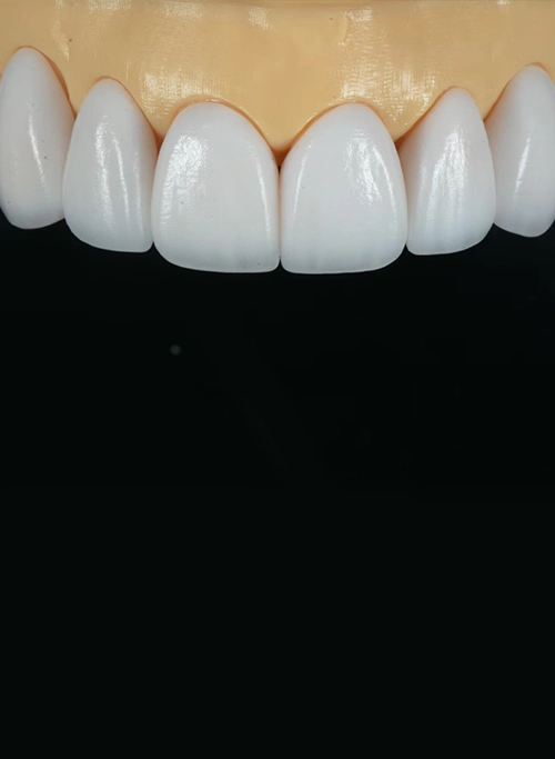 Dental Veneers
