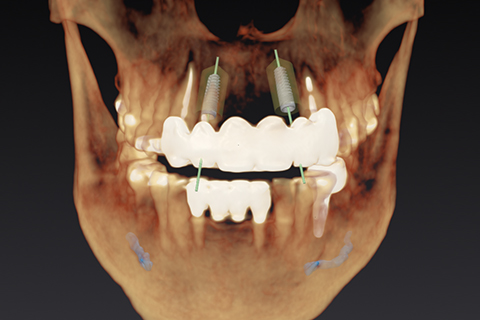 Dental Implants