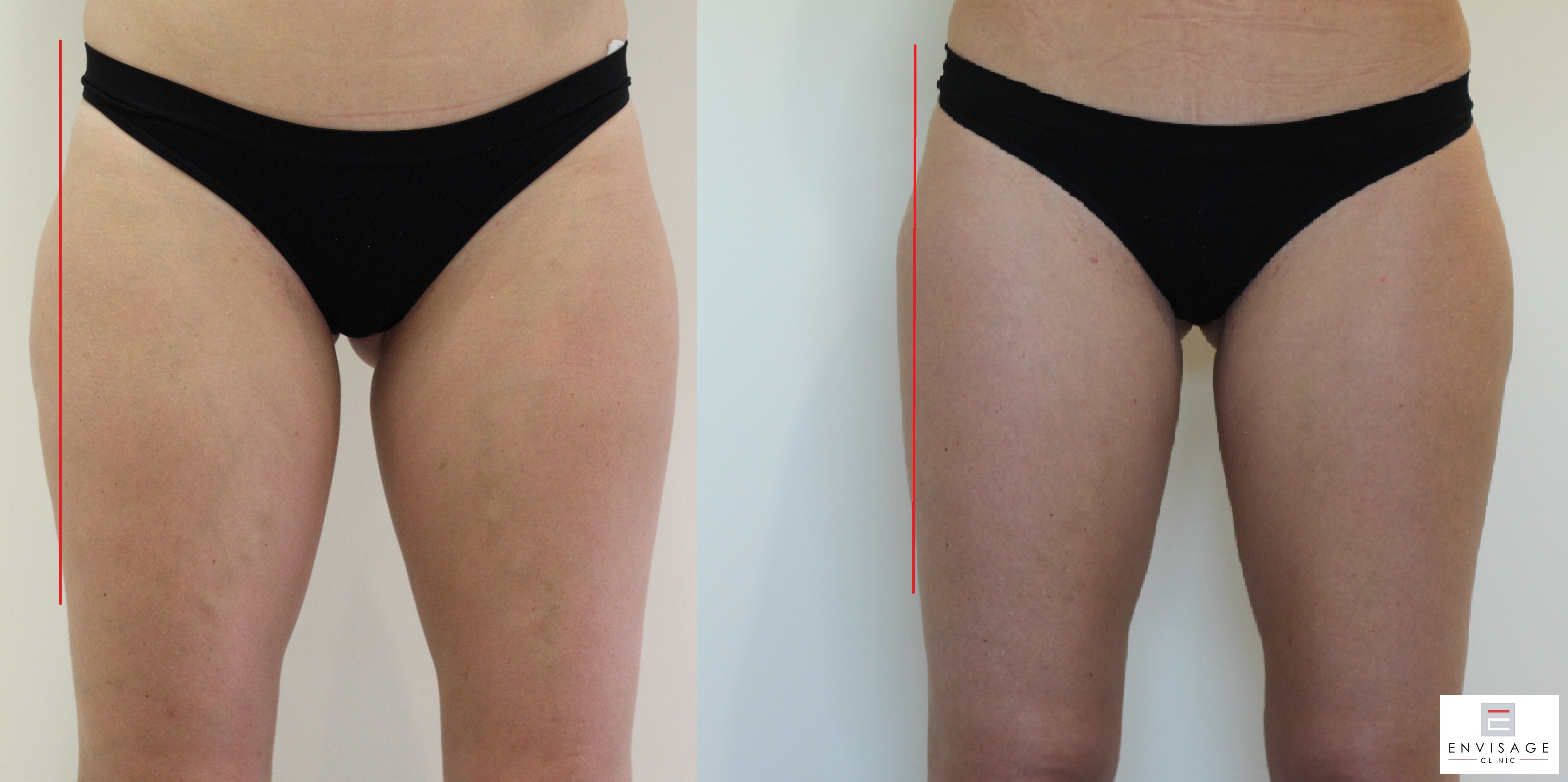 Before and after result from an Envisage Clinic body treatment course