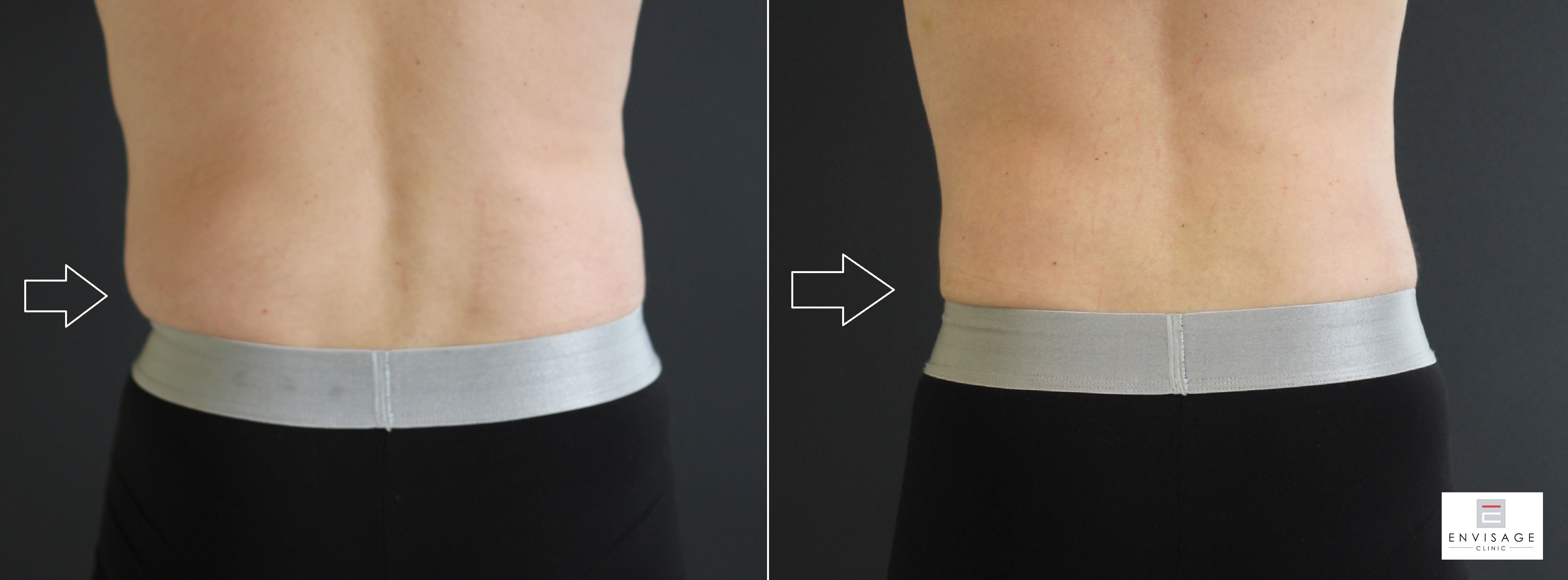 Before and after result from an Envisage Clinic body treatment course