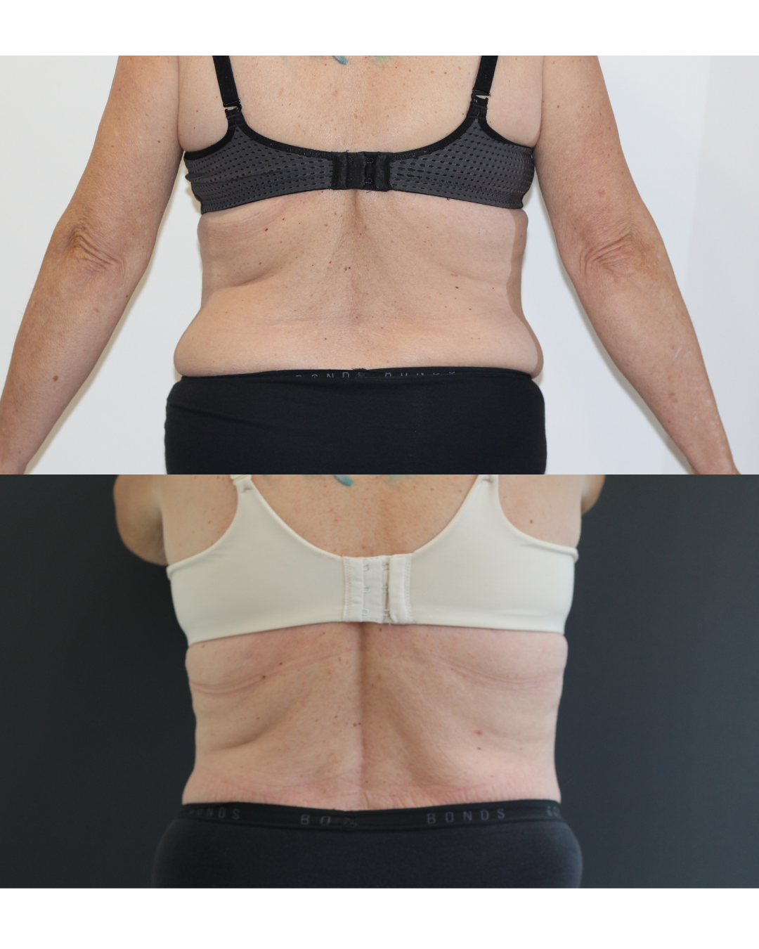 Before and after result from an Envisage Clinic body treatment course