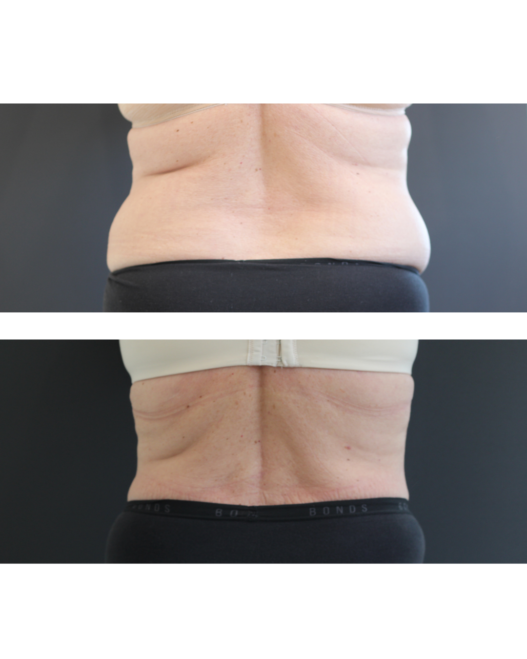 Before and after result from an Envisage Clinic body treatment course