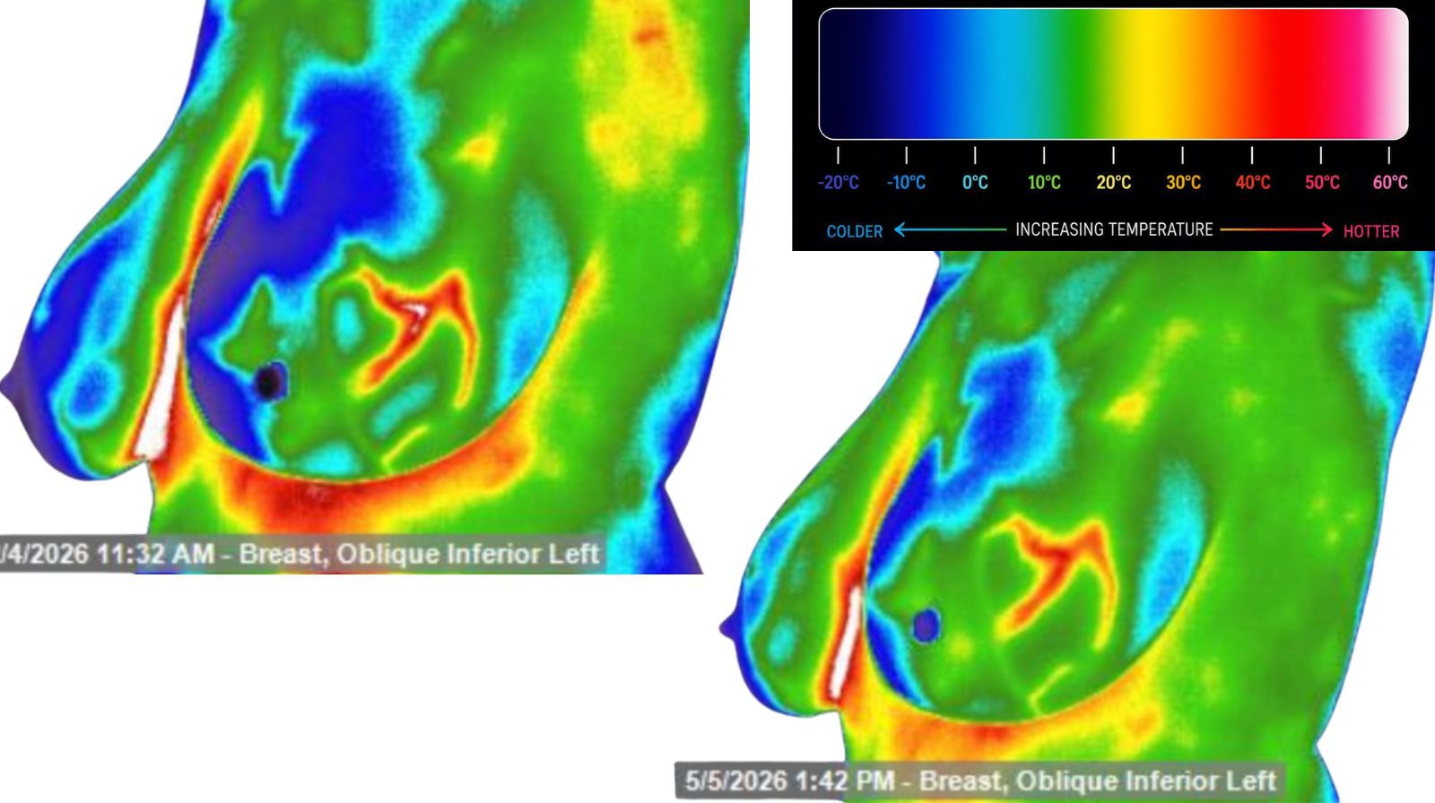 Comparison of left breast Thermography images take in February and May 2026, illustrating changes in thermal patterns over time alongside a temperature color scale