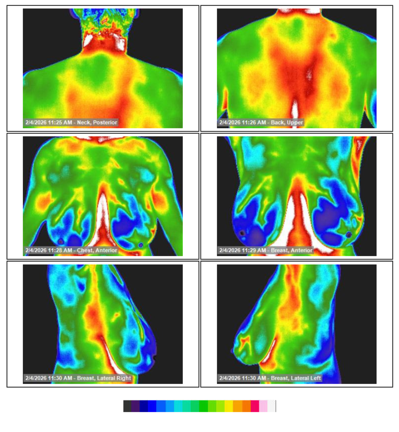 One page from a comprehensive baseline thermography screening showing multiple views of the neck, upper back, chest, and multiple breast views from a baseline thermography screening performed in February 2026.