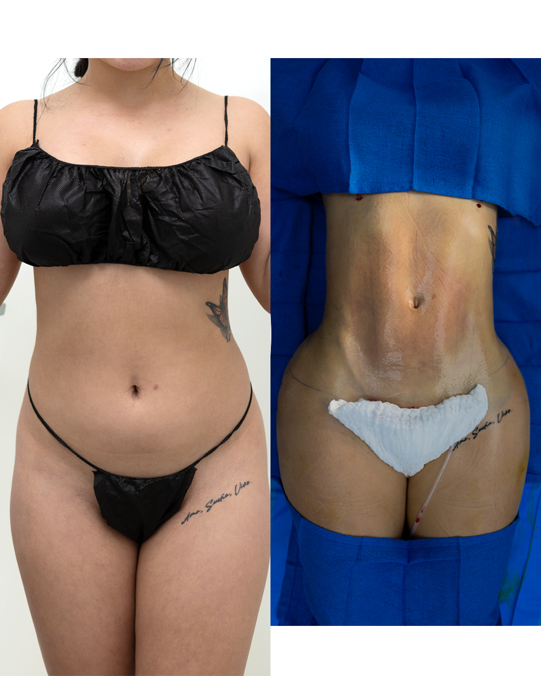 Antes y despues de liposuccion de alta definicion en Iboma Center