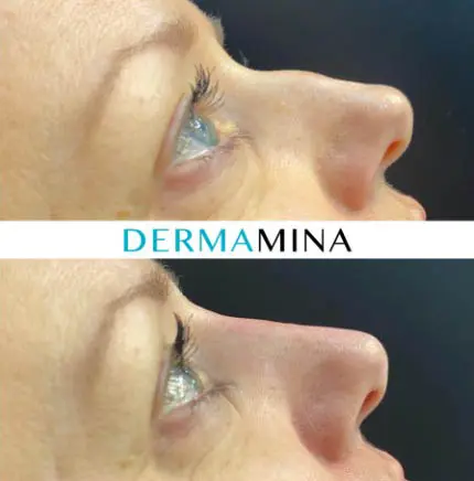 Before and after non-surgical rhinoplasty