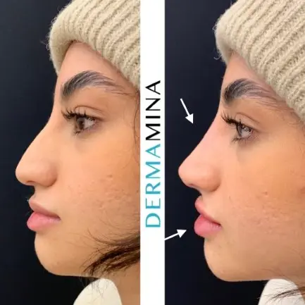 Before and after non-surgical rhinoplasty