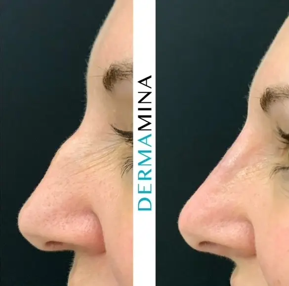 Before and after non-surgical rhinoplasty