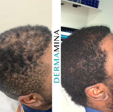 PRP hair treatment result