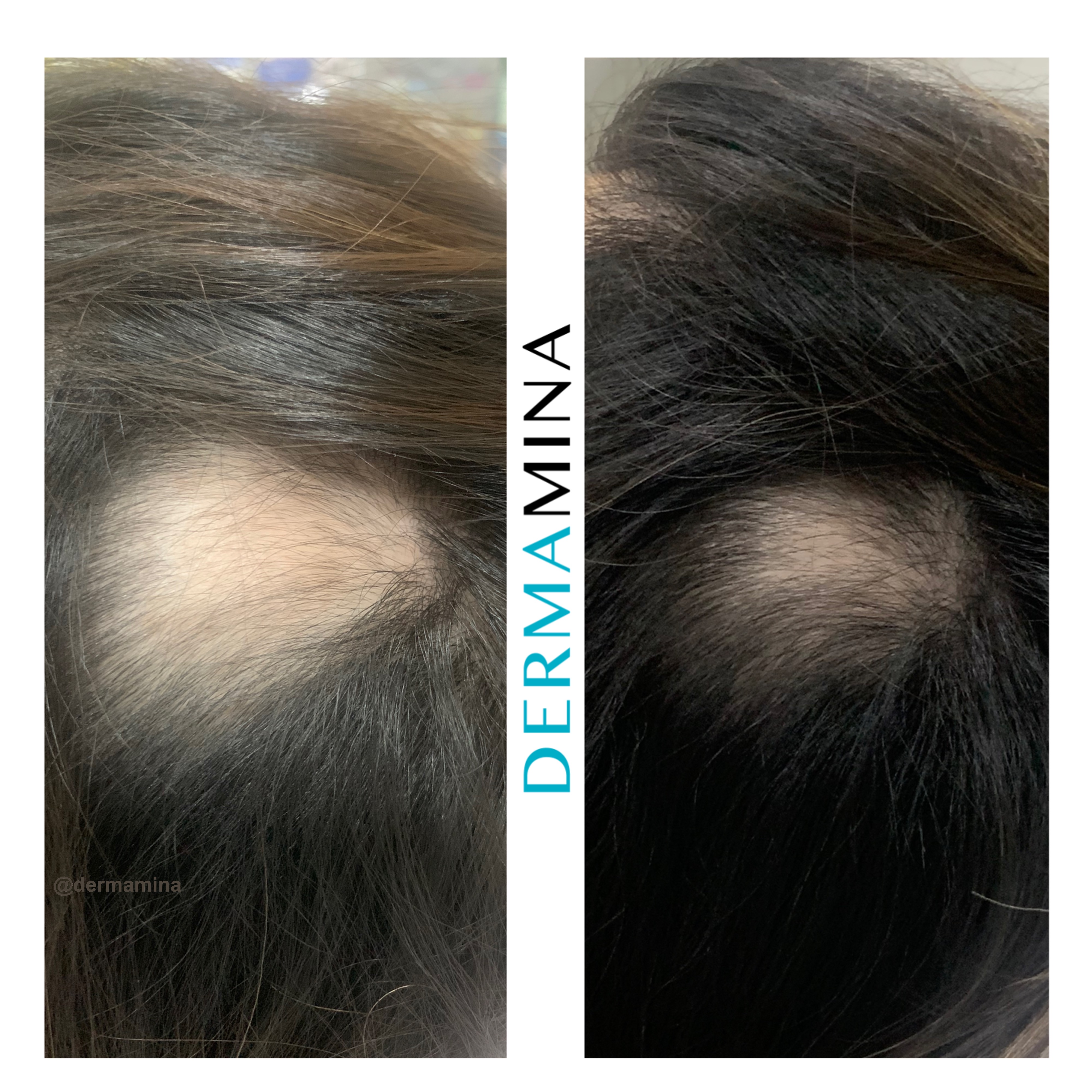PRP hair treatment result