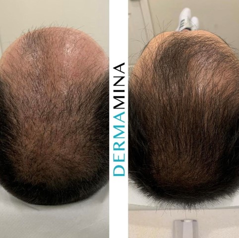 PRP hair treatment result