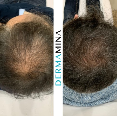 PRP hair treatment result