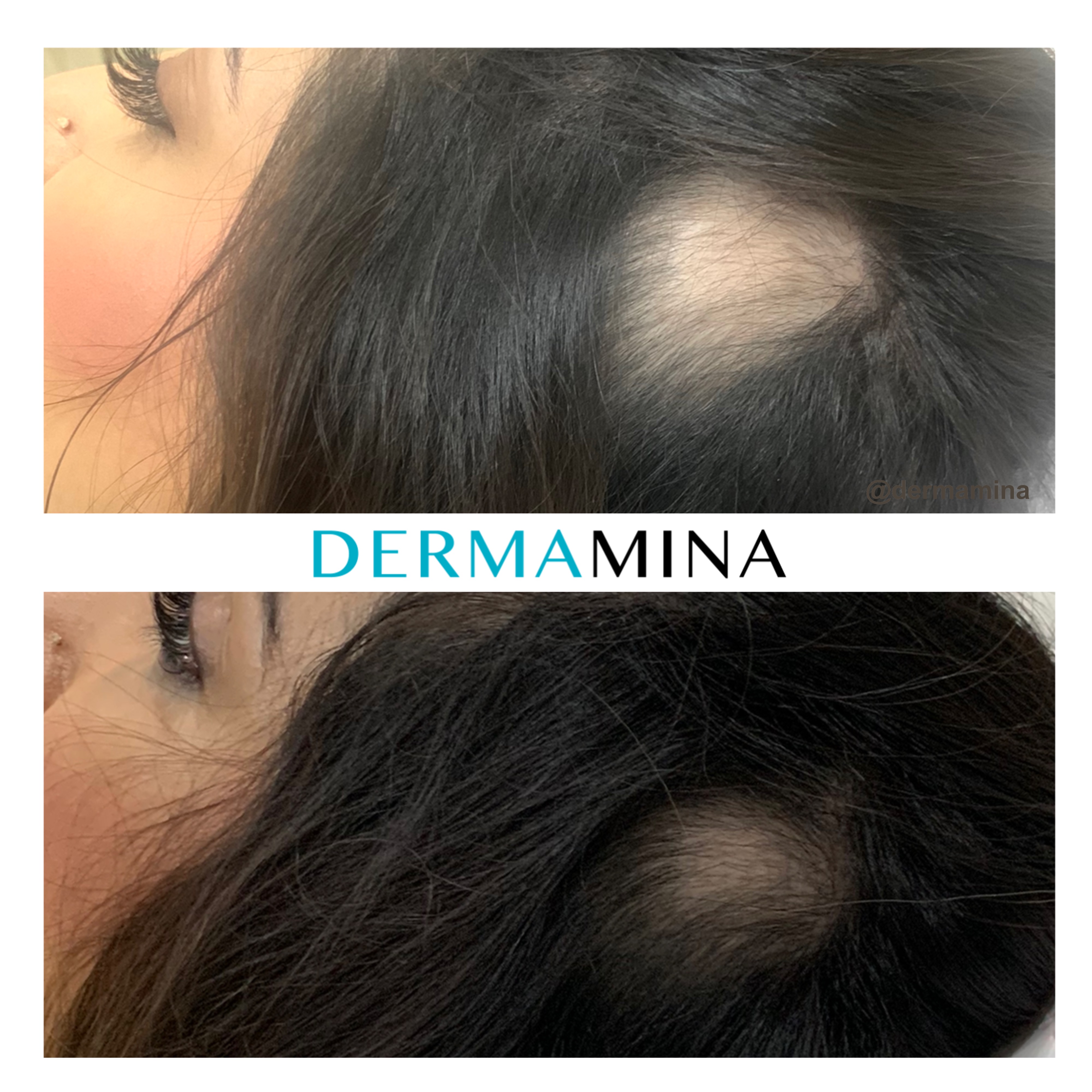 PRP hair treatment result