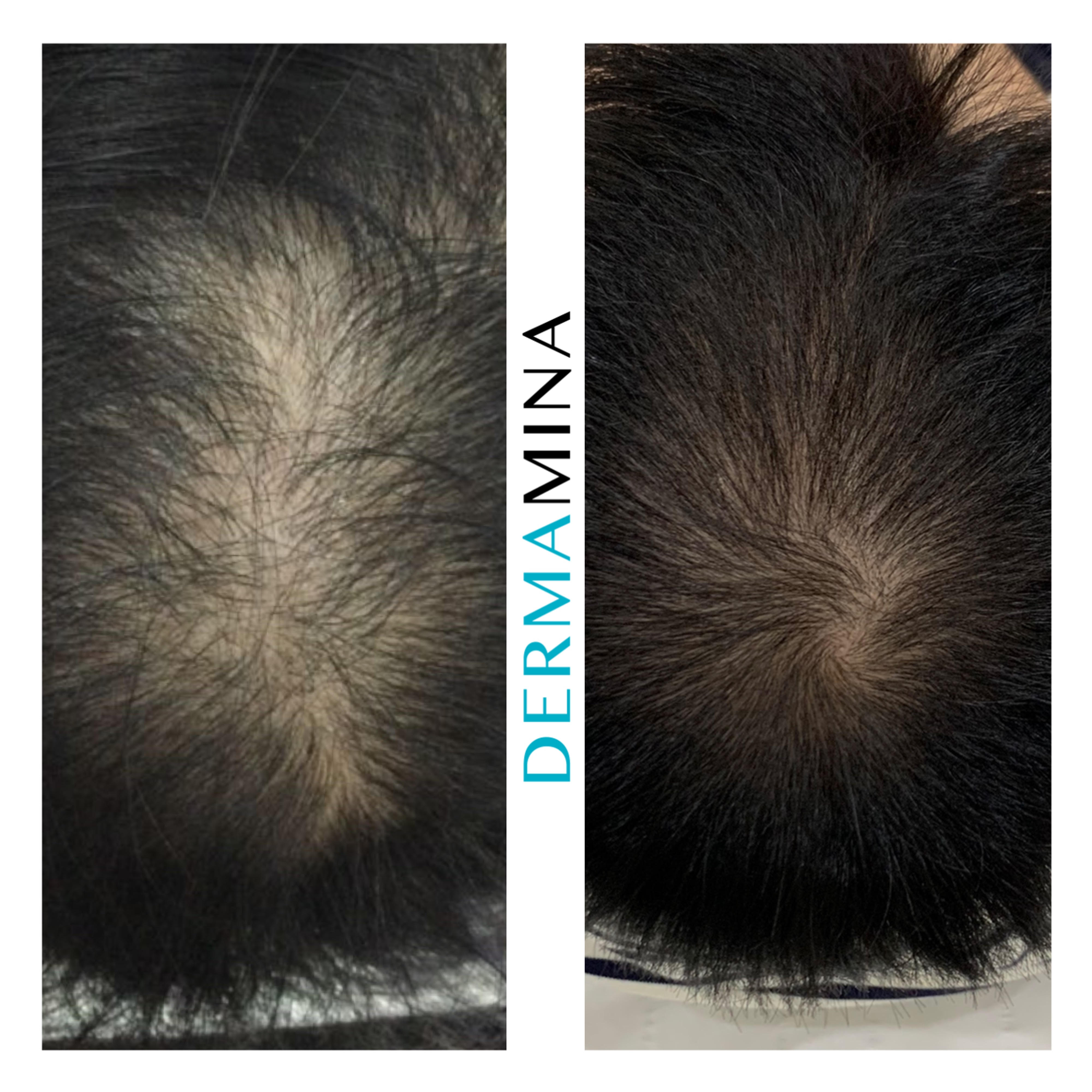 PRP hair treatment result